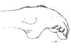 Wilsondesease.png